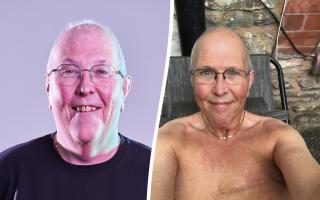 Jim Allen, 66, of Llangollen, watched a TV advert urging men to check for breast cancer and he came across a bump in the middle of his chest.