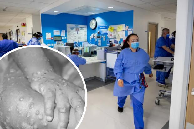 Monkeypox symptoms in humans amid new UK guidance - what we know. (PA/Canva)